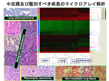Accuracy of pathological diagnosis of mesothelioma cases in Japan: Clinicopathological analysis of 382 cases